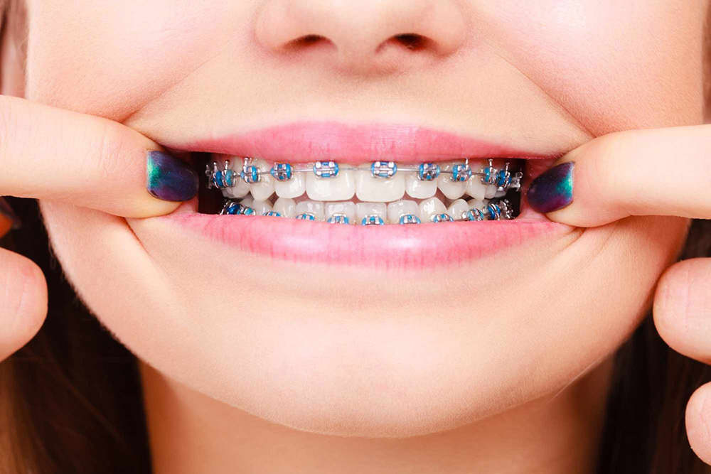 https://www.luxdental.com.au/wp-content/uploads/2021/04/braces1-1.jpg