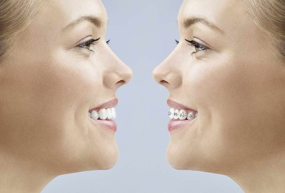 https://www.luxdental.com.au/wp-content/uploads/2021/04/invisalign-face-to-face-2.jpg