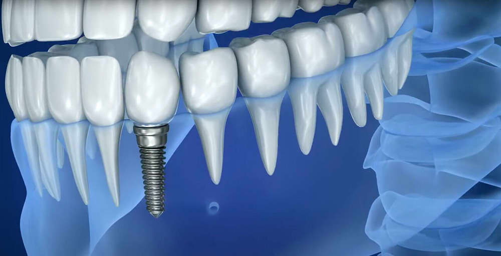 https://www.luxdental.com.au/wp-content/uploads/2021/05/dental-implant-inline2.jpg