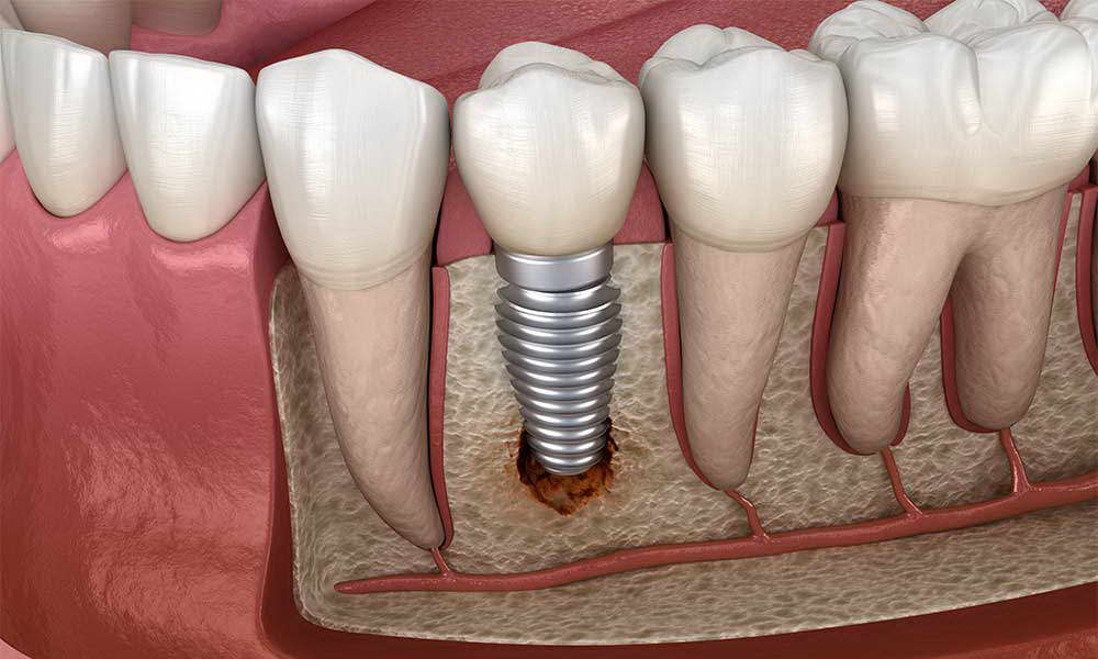 https://www.luxdental.com.au/wp-content/uploads/2021/05/dental-implant-inline3.jpg