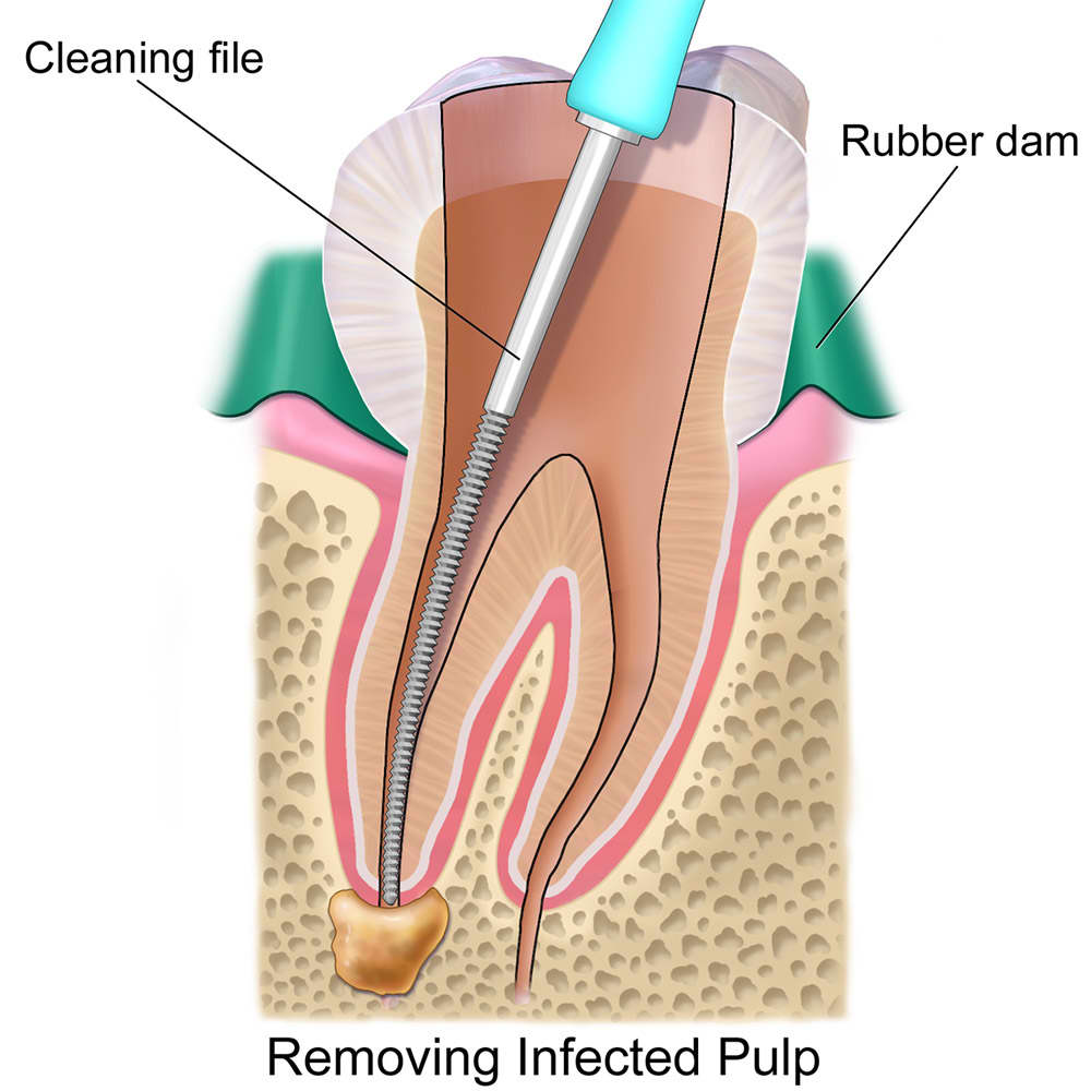 https://www.luxdental.com.au/wp-content/uploads/2021/05/rootcanal3.jpg
