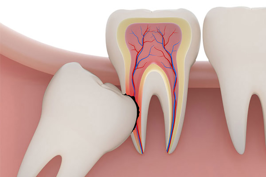 https://www.luxdental.com.au/wp-content/uploads/2021/05/wisdom-tooth-extraction.jpg
